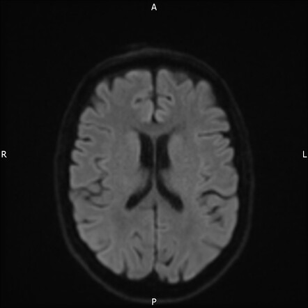 Developmental Venous Anomaly 