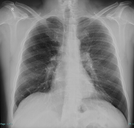 Solitary pulmonary nodule - incidental | Radiology Case | Radiopaedia.org