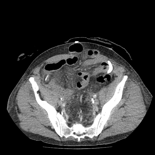 Postoperative abdominal wound dehiscence | Image | Radiopaedia.org