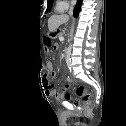 Postoperative abdominal wound dehiscence | Image | Radiopaedia.org