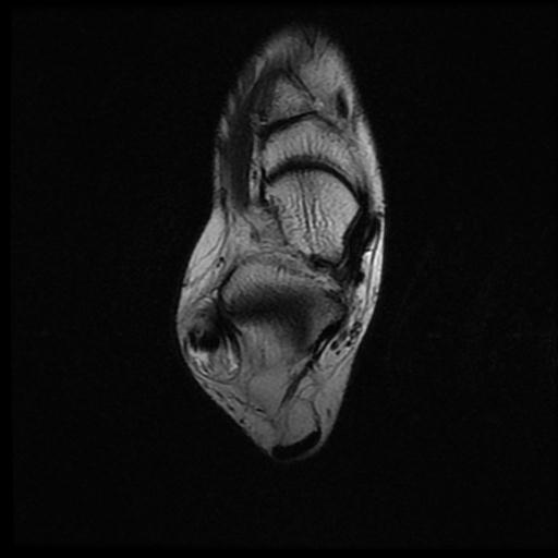 Peroneus brevis tendon split tear | Image | Radiopaedia.org