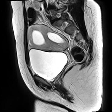 Ovarian torsion | Radiology Case | Radiopaedia.org