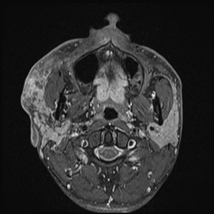 Lymphangioma of parotid gland | Image | Radiopaedia.org