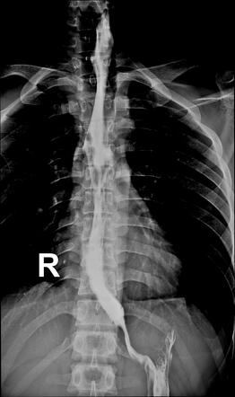 Achalasia | Radiology Case | Radiopaedia.org