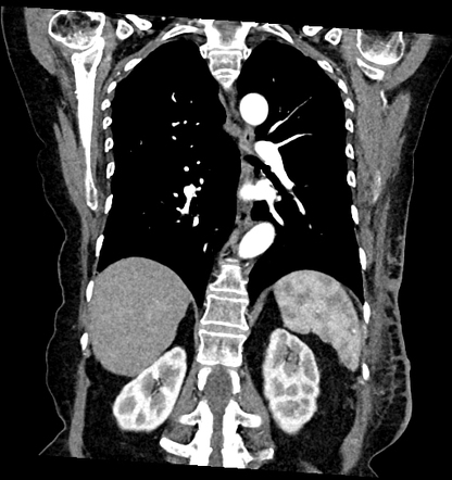 Cutaneous metastases - breast cancer | Radiology Case | Radiopaedia.org