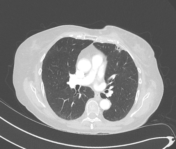 cutaneous-metastases