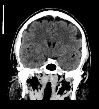 Dacryocystocele | Image | Radiopaedia.org