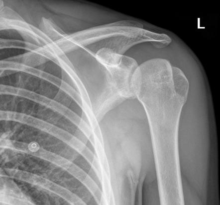 Hill-Sachs lesion | Radiology Case | Radiopaedia.org