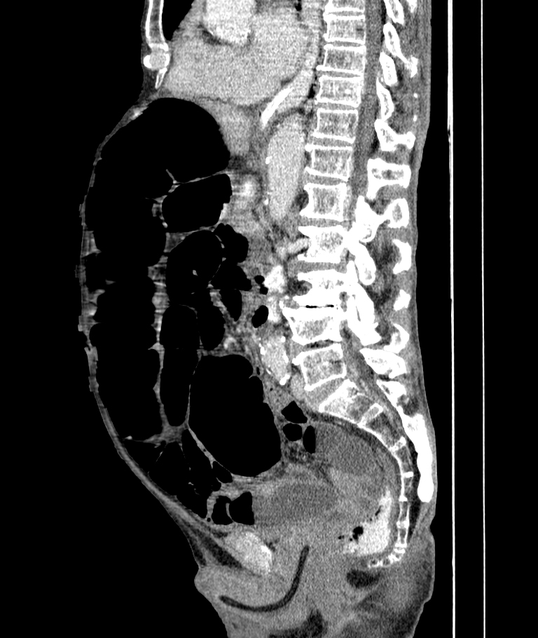 Sigmoid Volvulus Image