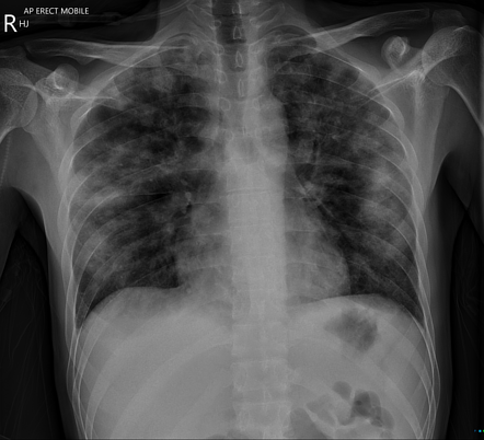 Pulmonary Pneumocystis jirovecii infection | Radiology Reference ...