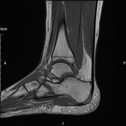 Acute complete anterior talofibular ligament tear | Radiology Case ...