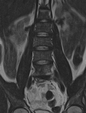 Brucella Spondylodiscitis - Lumbar | Image | Radiopaedia.org