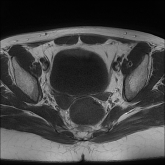 Hypogonadotrophic hypogonadism | Image | Radiopaedia.org