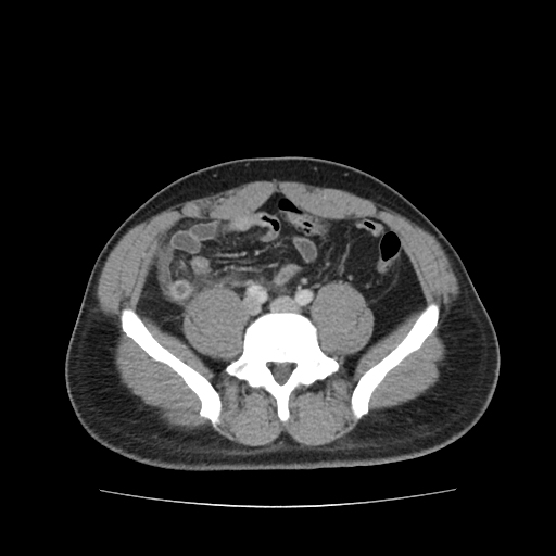 Acute Appendicitis Image