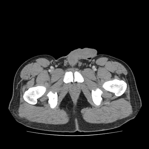 Acute Appendicitis Image