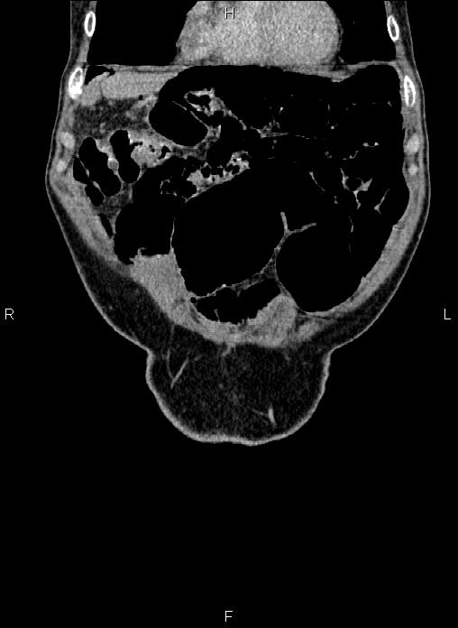 Pneumatosis cystoides intestinalis | Image | Radiopaedia.org