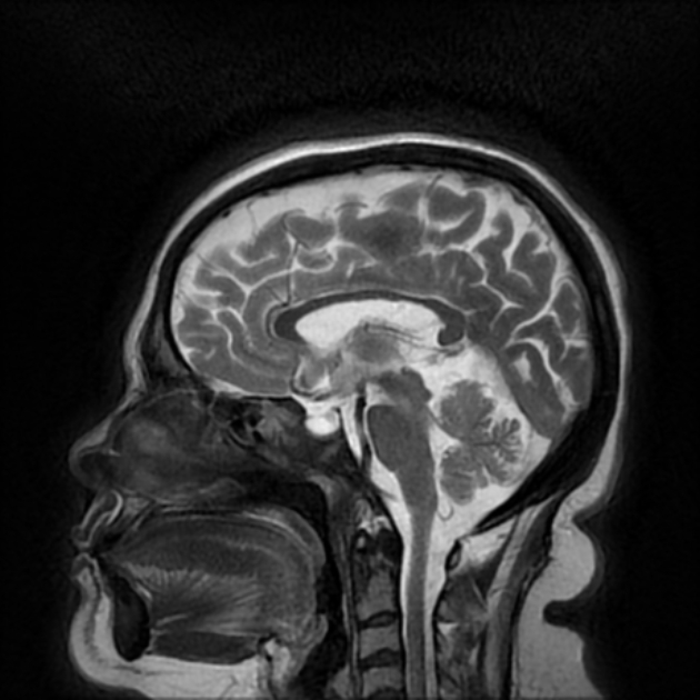 Churg-Strauss syndrome | Image | Radiopaedia.org