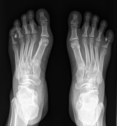 Interdigital corns (IDC) | Radiology Case | Radiopaedia.org