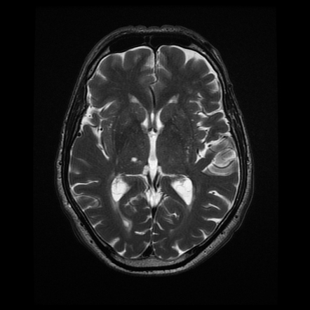 Posterior inferior cerebellar arterial infarct | Radiology Case ...