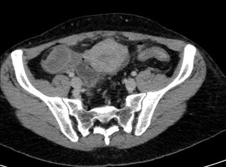 Hemorrhagic ovarian follicle cyst (CT) | Radiology Case | Radiopaedia.org