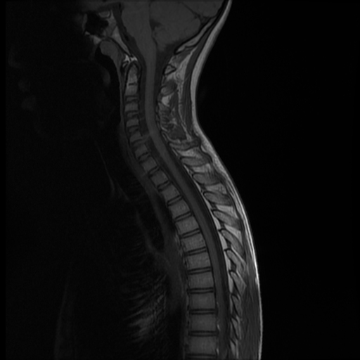 Spinal Hemangioblastoma 