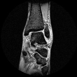 Anterior talofibular ligament tear | Image | Radiopaedia.org