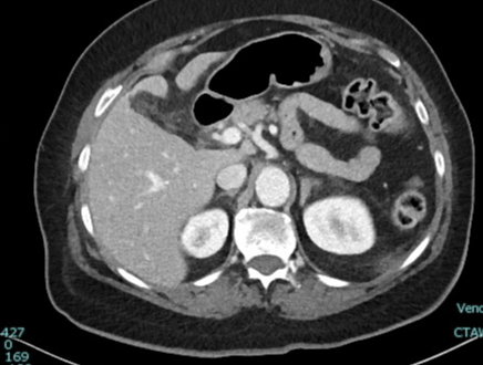 Cecal bascule | Image | Radiopaedia.org