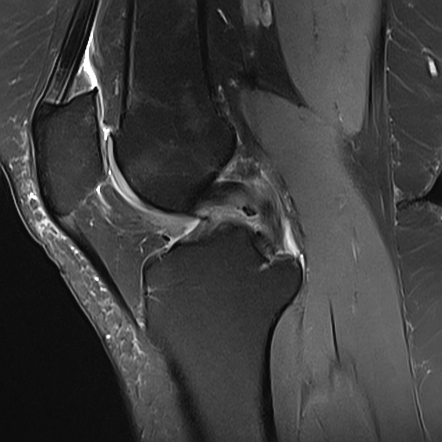 Synovial osteochondromatosis | Radiology Case | Radiopaedia.org