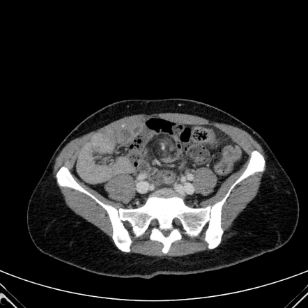 Abdominal whirl sign (whirlpool sign) of the mesentery | Radiology Case ...