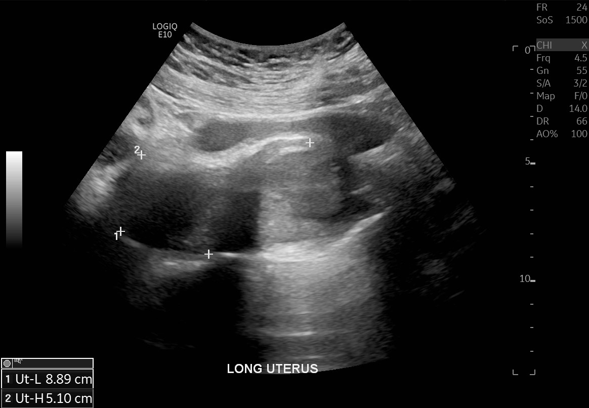 Tubo Ovarian Abscess In A Patient With Bicornuate Uterus Image 9080