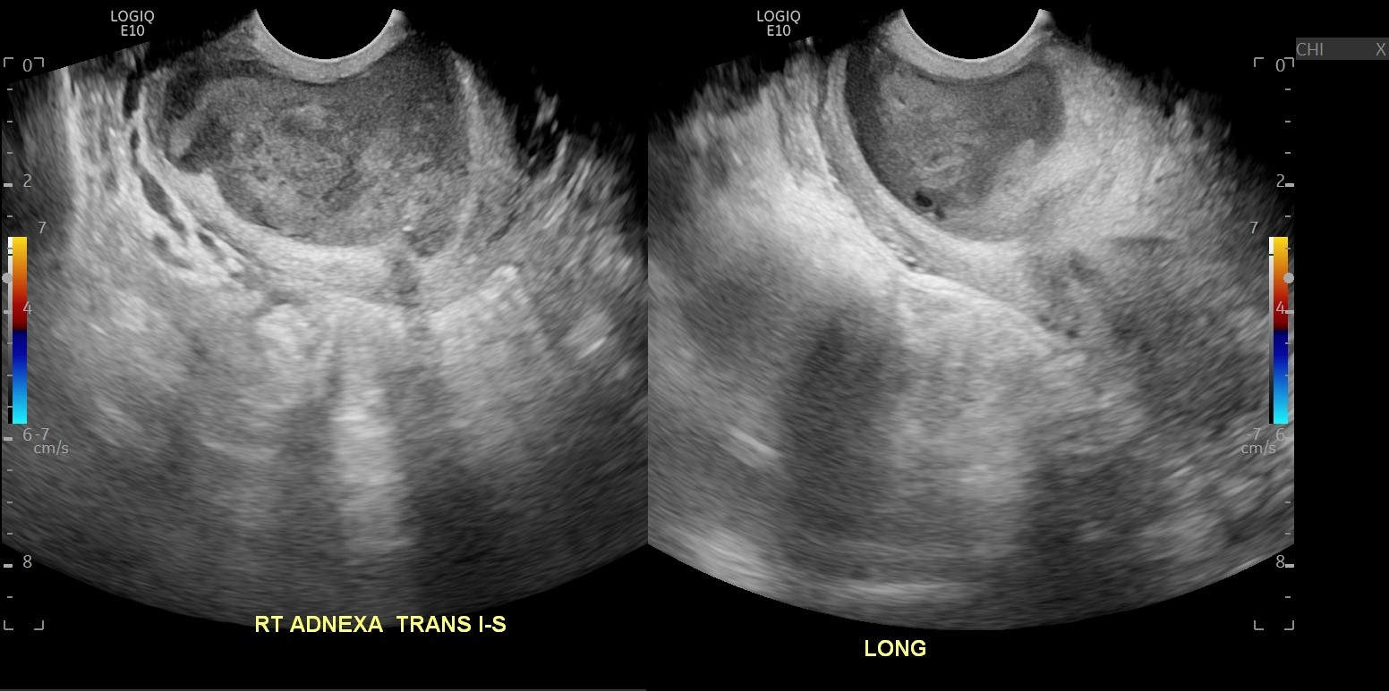 Tubo Ovarian Abscess In A Patient With Bicornuate Uterus Image