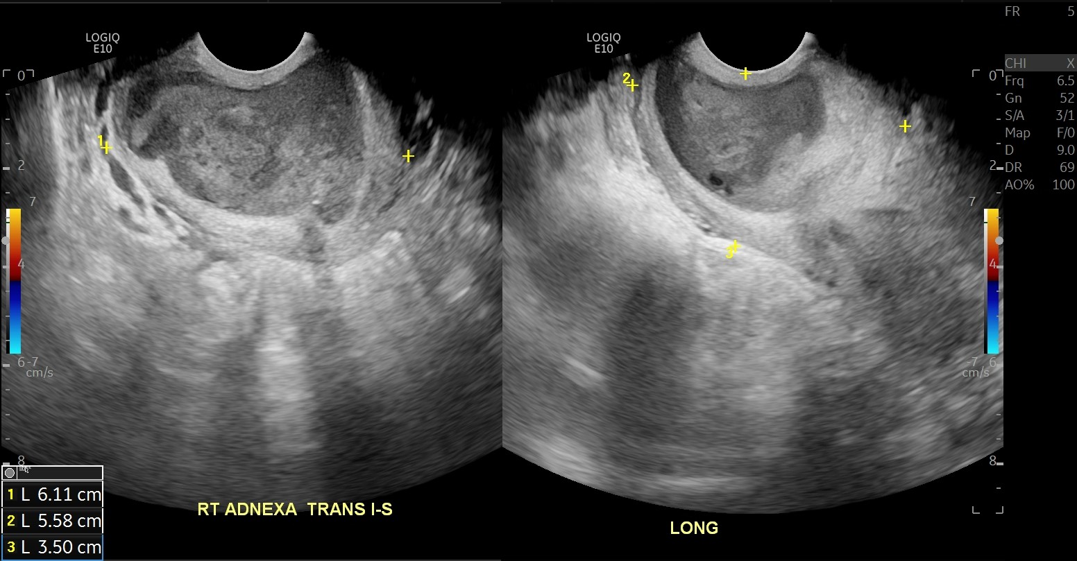 Tubo Ovarian Abscess In A Patient With Bicornuate Uterus Image