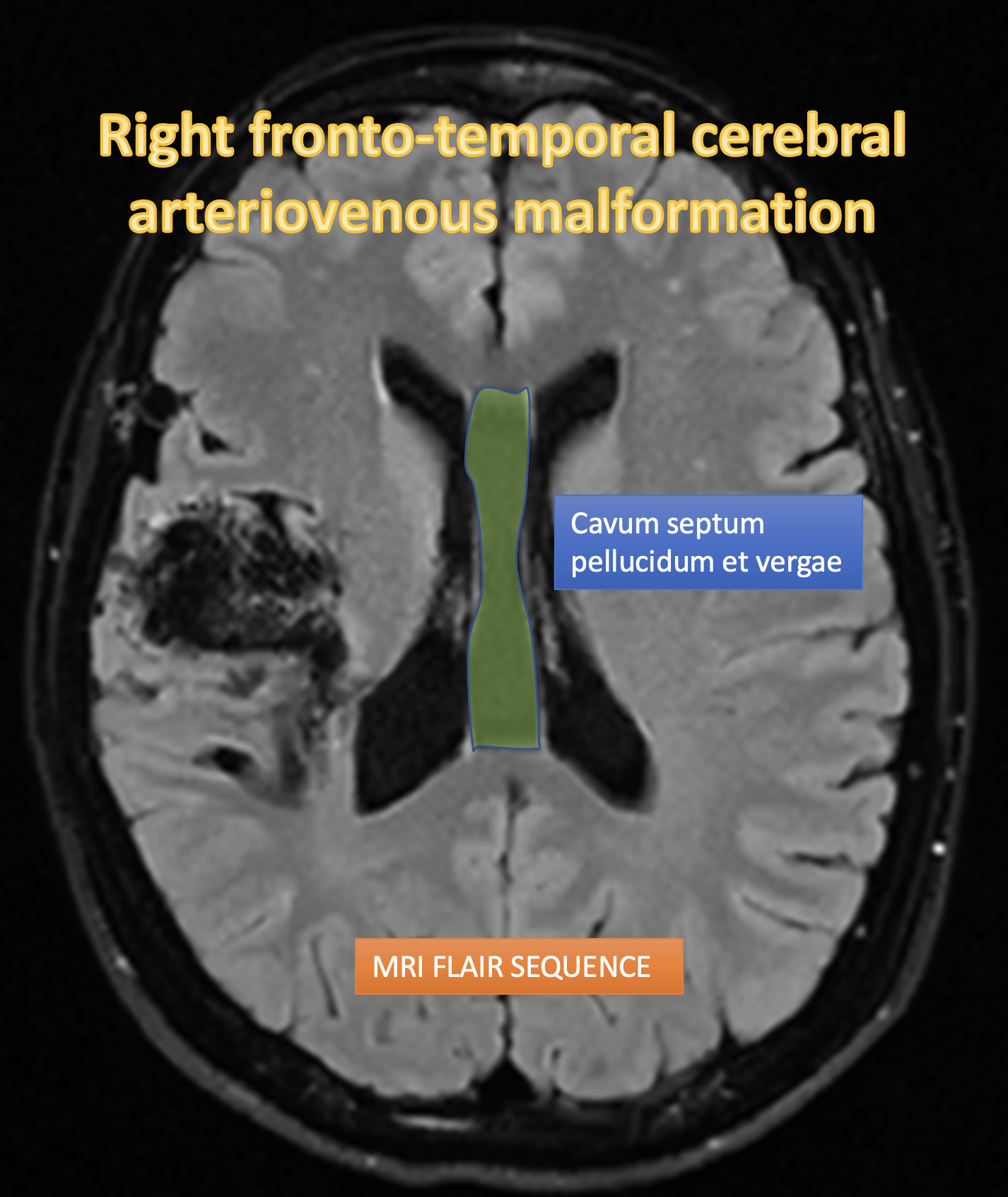 Cerebral Arteriovenous Malformation Image 5283