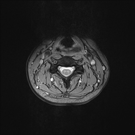 Normal Mri Cervical Spine Image Radiopaedia Org