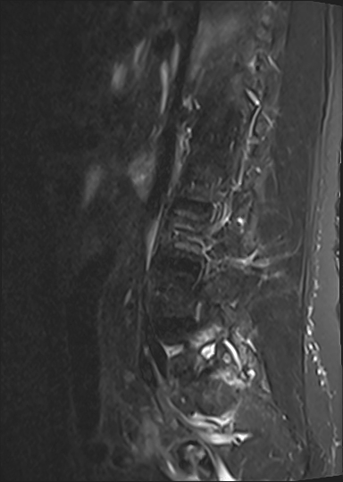 Facet Joint Arthropathy Image