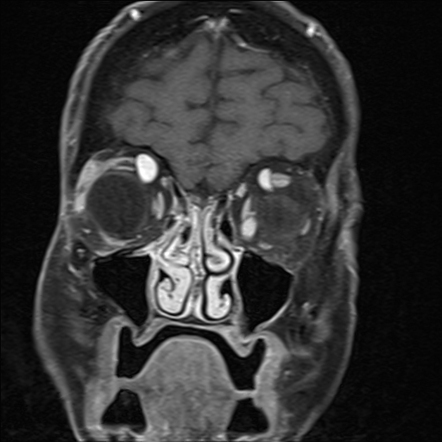 Orbital venous varices - multiple | Radiology Case | Radiopaedia.org