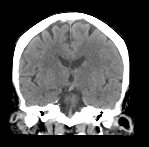 Orbital Venous Varices - Multiple 