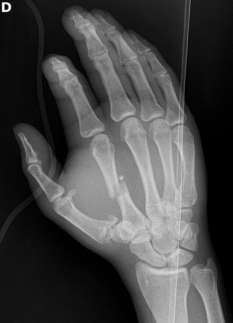 Rolando Fracture Image