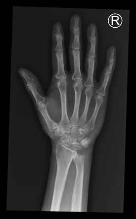 Distal radioulnar joint osteoarthritis | Radiology Case | Radiopaedia.org