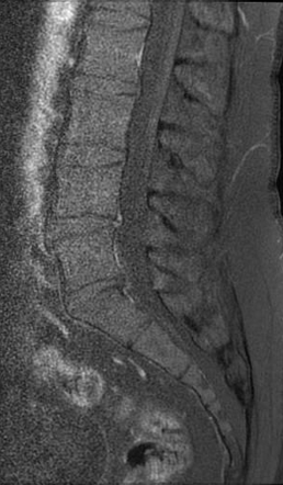 Disc sequestration | Image | Radiopaedia.org