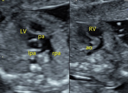 Transposition of the great arteries (TGA) - fetal echocardiogram ...