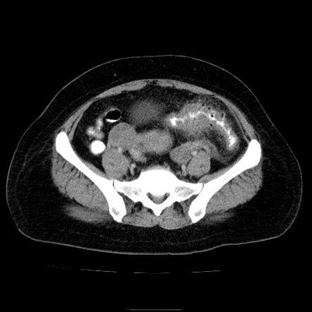 case study 42 acute diverticulitis