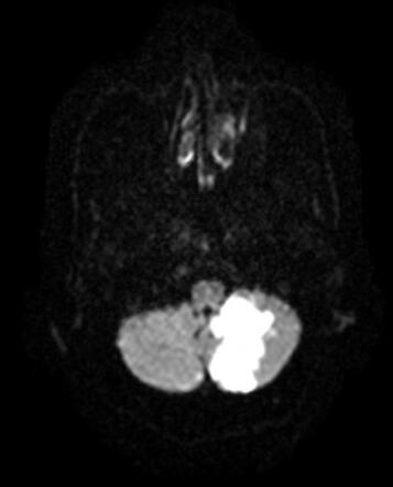 Posterior Inferior Cerebellar Artery Pica Infarct Image Radiopaedia Org