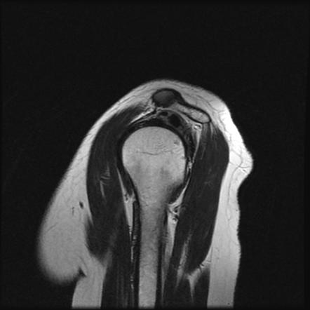 Supraspinatus Calcific Tendinitis | Radiology Case | Radiopaedia.org