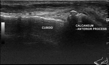 Midtarsal sprain - ultrasound | Radiology Case | Radiopaedia.org