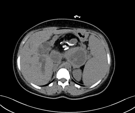 Retroperitoneal teratoma | Radiology Case | Radiopaedia.org