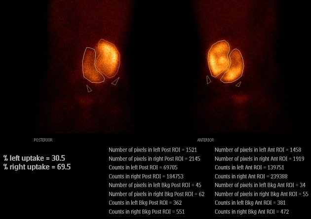 Cureus  A Rare Case of Posterior Vaginal Wall Gartner's Duct Cyst