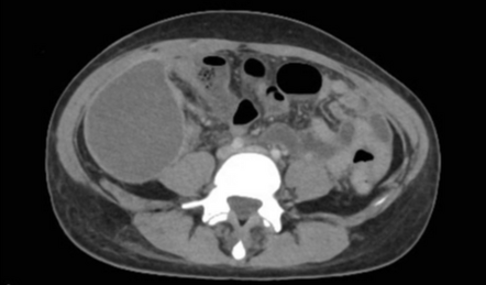 Postsurgical Pelvic And Abdominal Abscesses | Radiology Case ...