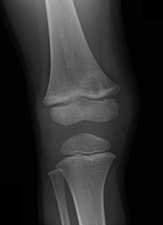 Distal femoral cortical irregularity | Radiology Case | Radiopaedia.org