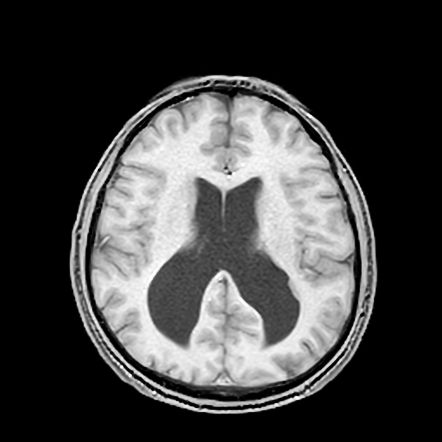 Subependymal heterotopia | Radiology Case | Radiopaedia.org